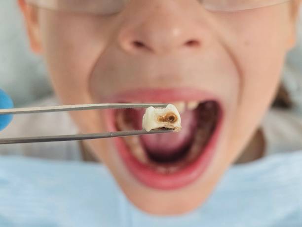 Best Emergency Wisdom Teeth Removal in Jackpot, NV